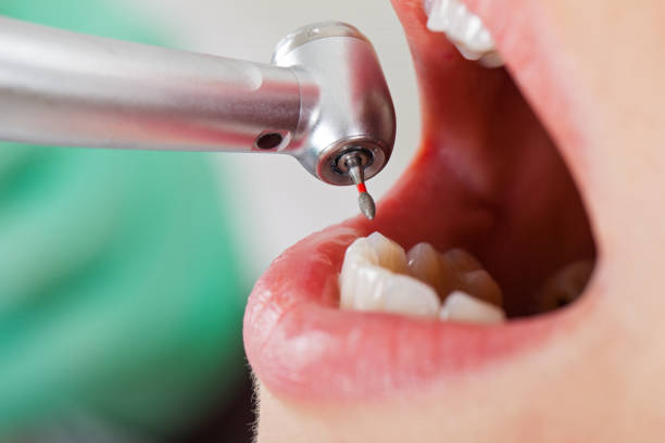 Best Emergency Root Canal Treatment in Kensington, MD